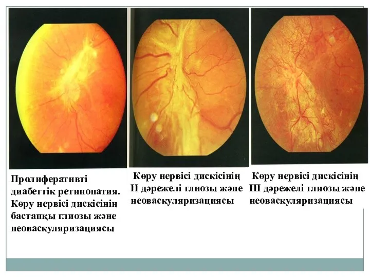 Пролиферативті диабеттік ретинопатия. Көру нервісі дискісінің бастапқы глиозы және неоваскуляризациясы Көру нервісі дискісінің