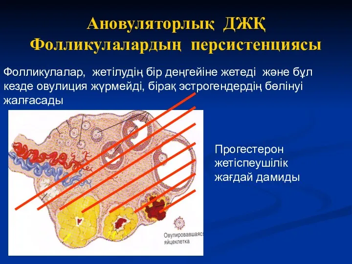 Ановуляторлық ДЖҚ Фолликулалардың персистенциясы Фолликулалар, жетілудің бір деңгейіне жетеді және