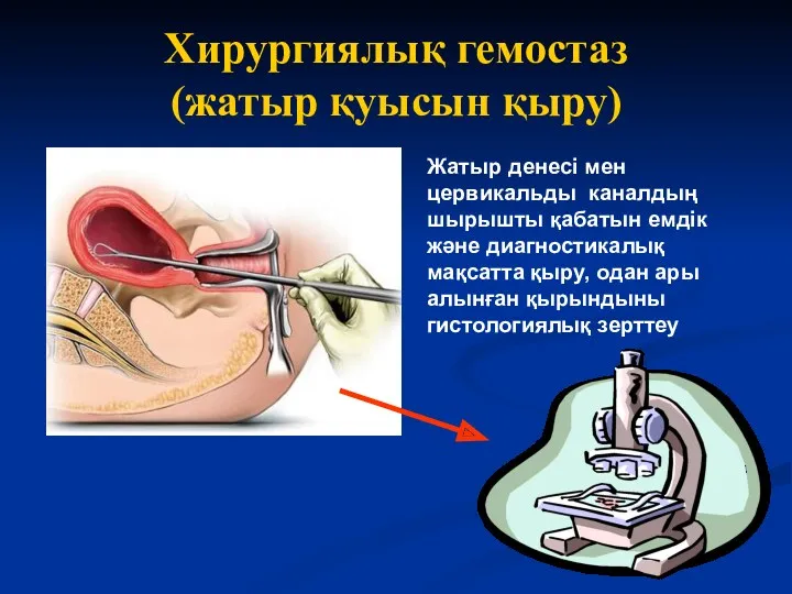 Хирургиялық гемостаз (жатыр қуысын қыру) Жатыр денесі мен цервикальды каналдың