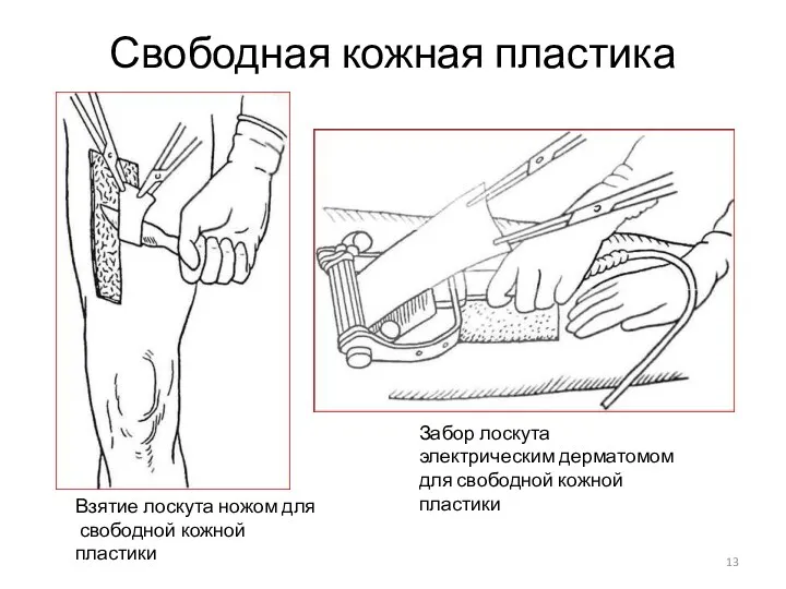 Свободная кожная пластика Взятие лоскута ножом для свободной кожной пластики