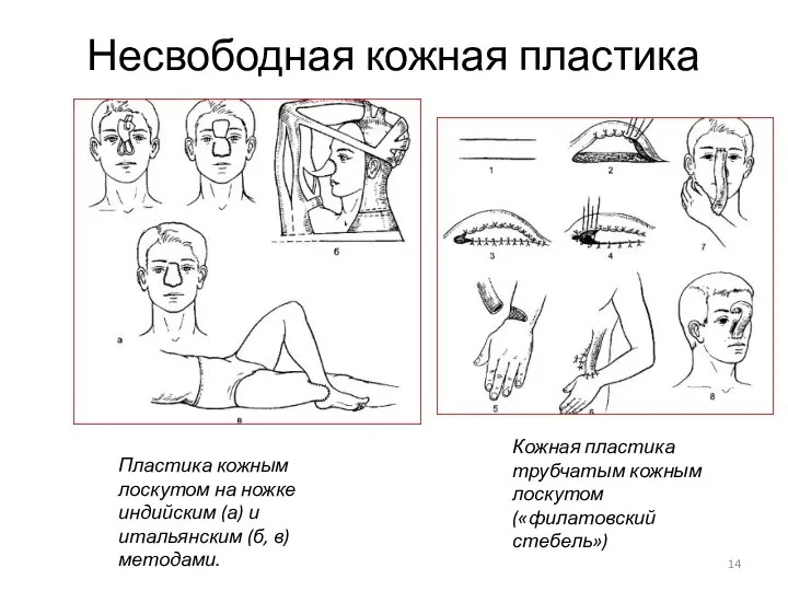 Несвободная кожная пластика Пластика кожным лоскутом на ножке индийским (а)