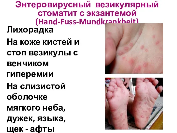 Энтеровирусный везикулярный стоматит с экзантемой (Hand-Fuss-Mundkrankheit) Лихорадка На коже кистей