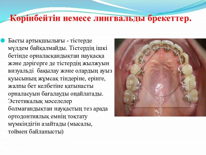 Көрінбейтін немесе лингвальды брекеттер. Басты артықшылығы - тістерде мүлдем байқалмайды.