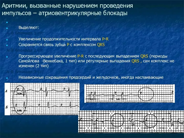 Аритмии, вызванные нарушением проведения импульсов – атриовентрикулярные блокады А-В блокады