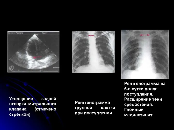 Утолщение задней створки митрального клапана (отмечено стрелкой) Рентгенограмма грудной клетки