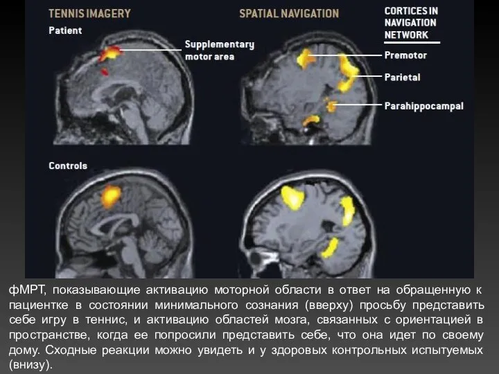 фМРТ, показывающие активацию моторной области в ответ на обращенную к пациентке в состоянии