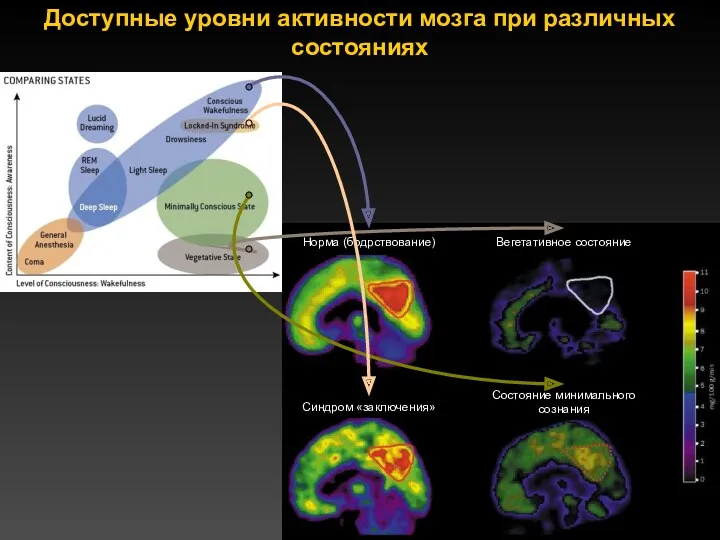 Доступные уровни активности мозга при различных состояниях Норма (бодрствование) Вегетативное состояние Состояние минимального сознания Синдром «заключения»