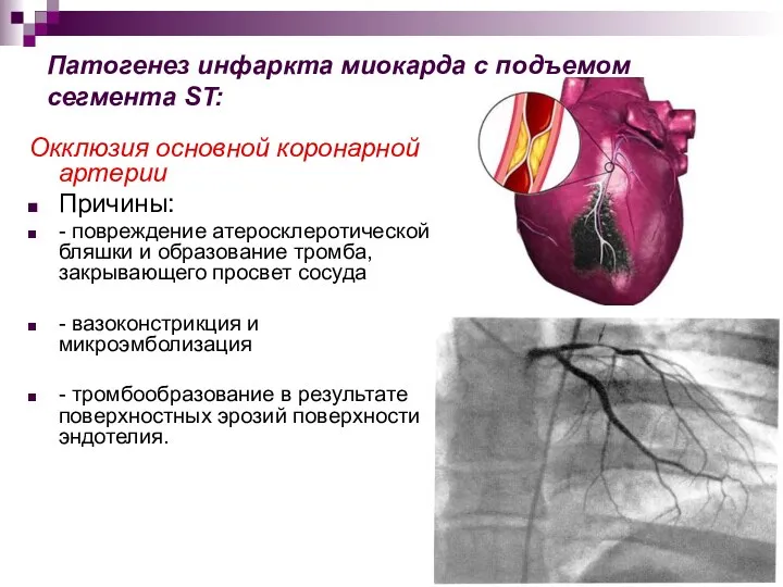 Патогенез инфаркта миокарда с подъемом сегмента ST: Окклюзия основной коронарной артерии Причины: -