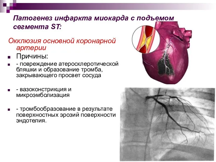 Патогенез инфаркта миокарда с подъемом сегмента ST: Окклюзия основной коронарной