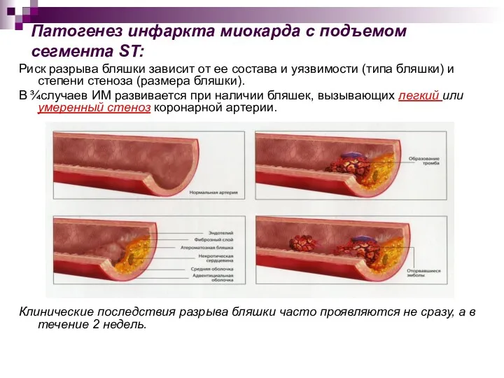 Патогенез инфаркта миокарда с подъемом сегмента ST: Риск разрыва бляшки зависит от ее