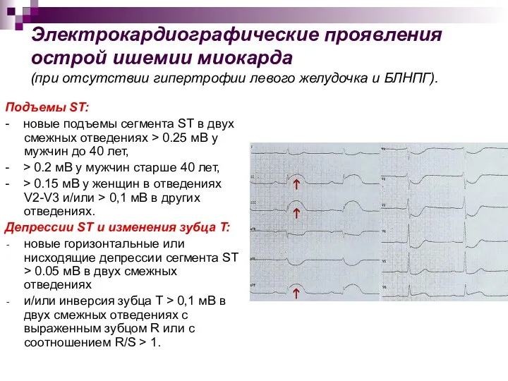 Электрокардиографические проявления острой ишемии миокарда (при отсутствии гипертрофии левого желудочка и БЛНПГ). Подъемы