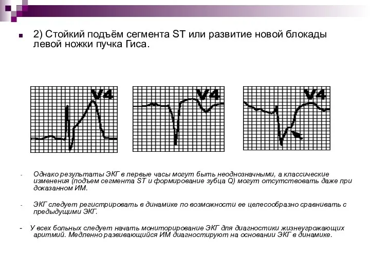 2) Стойкий подъём сегмента ST или развитие новой блокады левой ножки пучка Гиса.