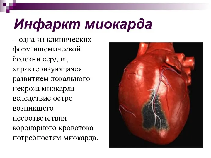 Инфаркт миокарда – одна из клинических форм ишемической болезни сердца, характеризующаяся развитием локального