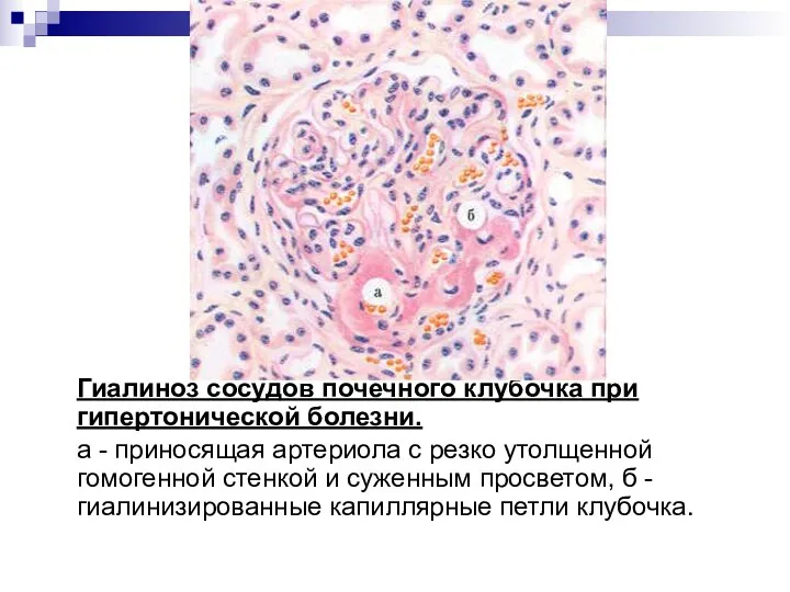 Гиалиноз сосудов почечного клубочка при гипертонической болезни. а - приносящая артериола с резко