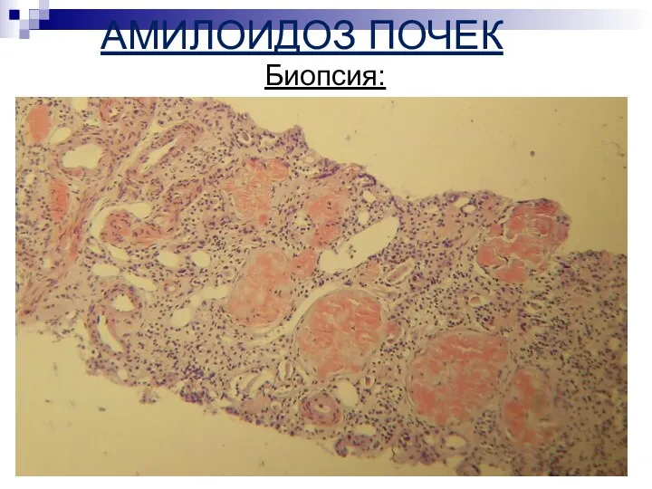 АМИЛОИДОЗ ПОЧЕК Биопсия: