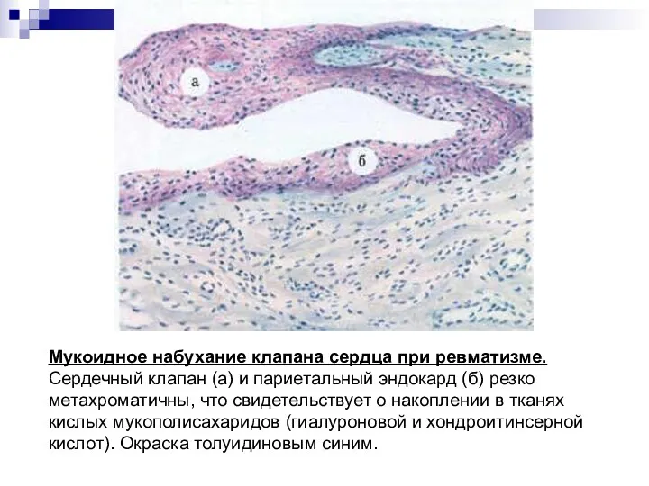 Мукоидное набухание клапана сердца при ревматизме. Сердечный клапан (а) и париетальный эндокард (б)