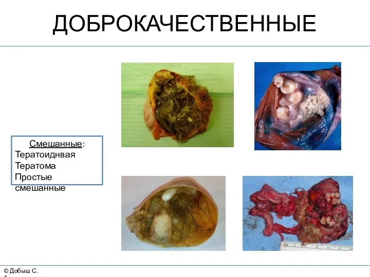 © Добыш С.А. ДОБРОКАЧЕСТВЕННЫЕ Смешанные: Тератоиднвая Тератома Простые смешанные