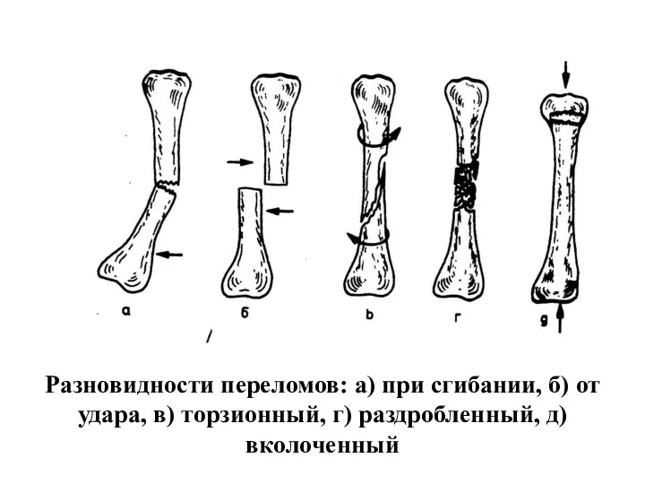 Разновидности переломов: а) при сгибании, б) от удара, в) торзионный, г) раздробленный, д) вколоченный