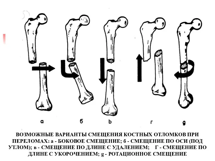 ВОЗМОЖНЫЕ ВАРИАНТЫ СМЕЩЕНИЯ КОСТНЫХ ОТЛОМКОВ ПРИ ПЕРЕЛОМАХ: а - БОКОВОЕ