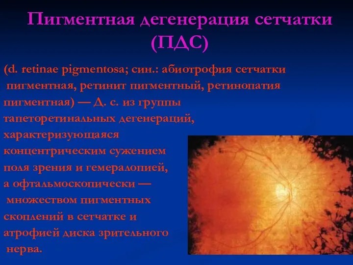 Пигментная дегенерация сетчатки (ПДС) (d. retinae pigmentosa; син.: абиотрофия сетчатки