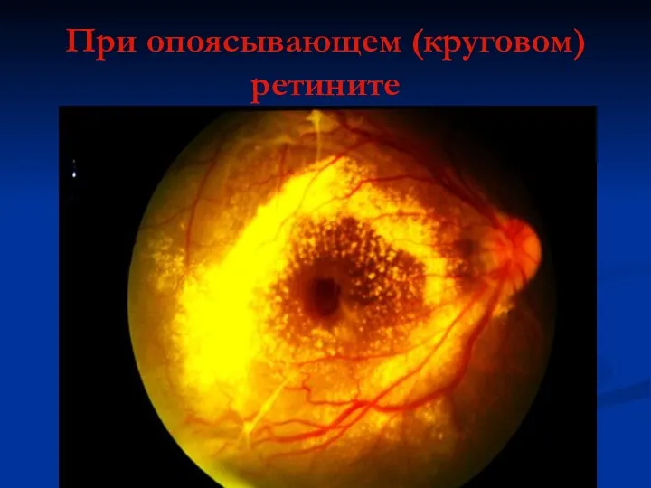 При опоясывающем (круговом) ретините