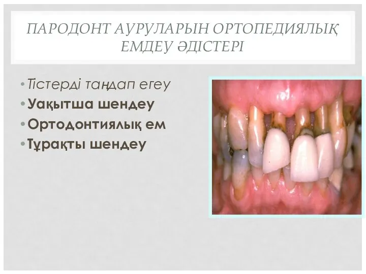 ПАРОДОНТ АУРУЛАРЫН ОРТОПЕДИЯЛЫҚ ЕМДЕУ ӘДІСТЕРІ Тістерді таңдап егеу Уақытша шендеу Ортодонтиялық ем Тұрақты шендеу