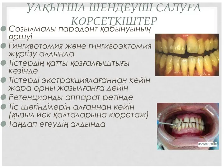 УАҚЫТША ШЕНДЕУІШ САЛУҒА КӨРСЕТКІШТЕР Созылмалы пародонт қабынуының өршуі Гингивотомия және