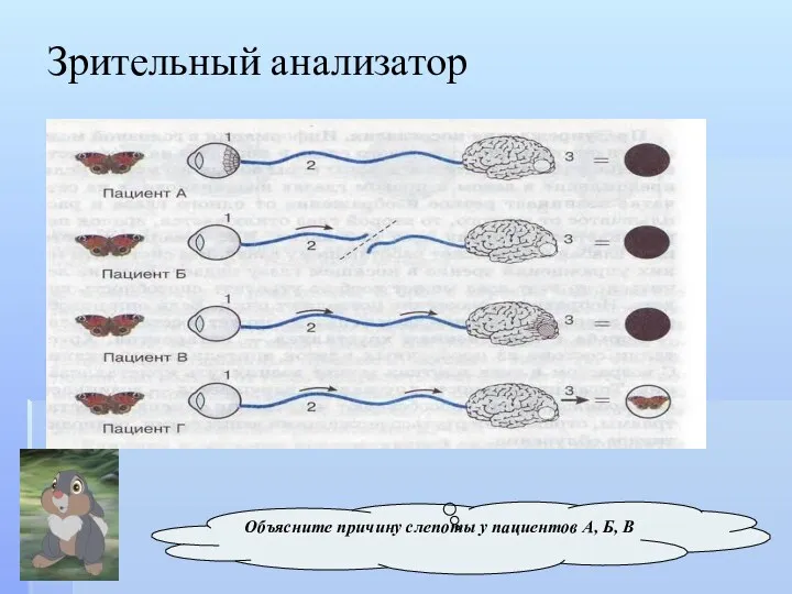 Зрительный анализатор Объясните причину слепоты у пациентов А, Б, В