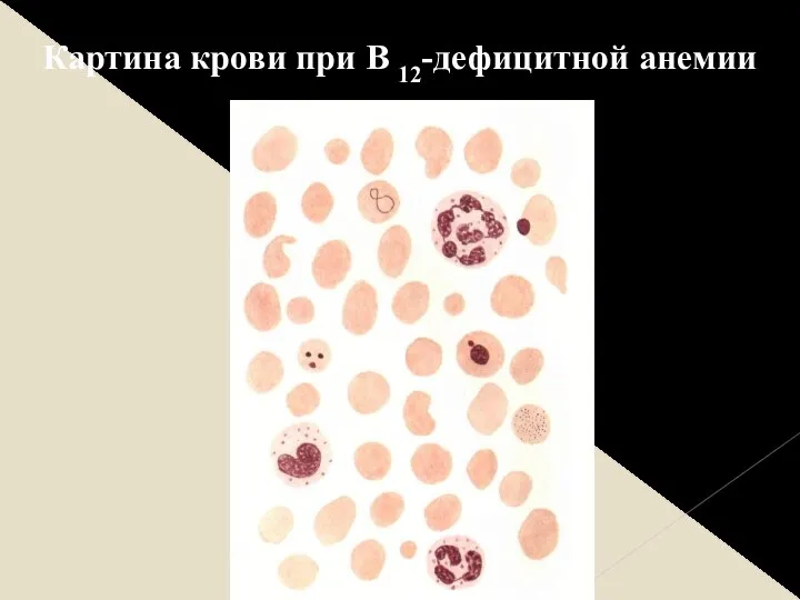 Картина крови при В 12-дефицитной анемии