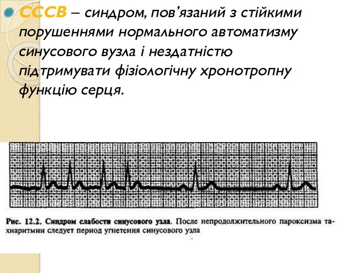 СССВ – синдром, пов’язаний з стійкими порушеннями нормального автоматизму синусового