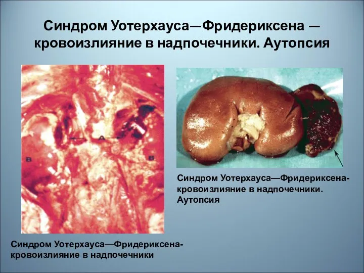 Синдром Уотерхауса—Фридериксена — кровоизлияние в надпочечники. Аутопсия Синдром Уотерхауса—Фридериксена- кровоизлияние