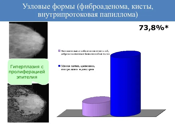 Узловые формы (фиброаденома, кисты, внутрипротоковая папиллома) Гиперплазия с пролиферацией эпителия 73,8%*