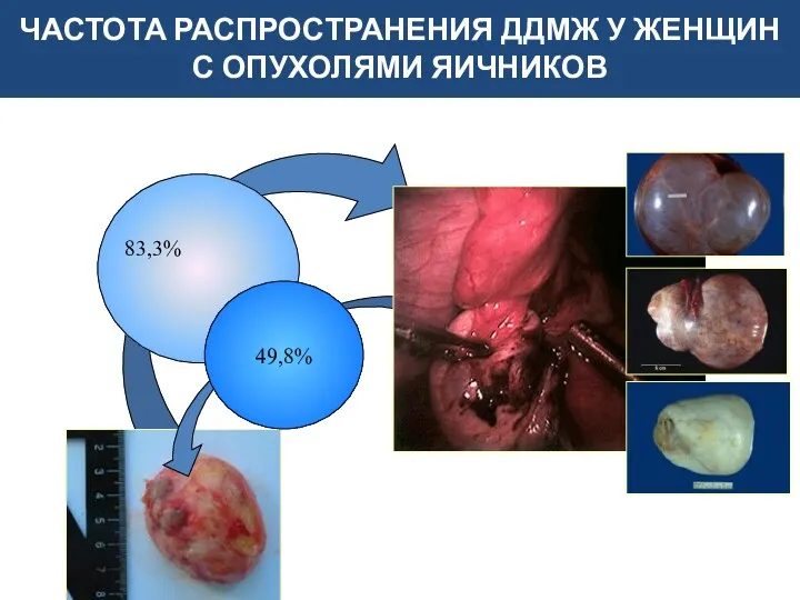 ЧАСТОТА РАСПРОСТРАНЕНИЯ ДДМЖ У ЖЕНЩИН С ОПУХОЛЯМИ ЯИЧНИКОВ 83,3% 49,8%