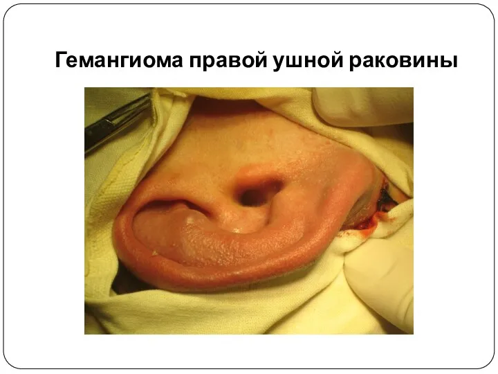 Гемангиома правой ушной раковины