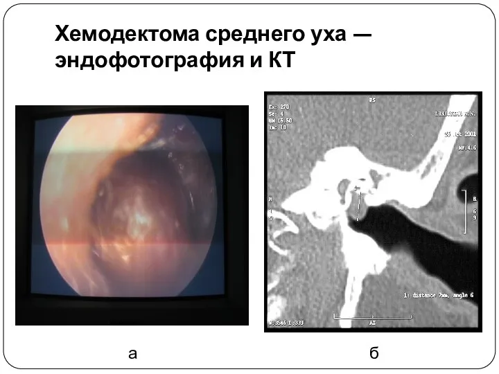 Хемодектома среднего уха — эндофотография и КТ а б