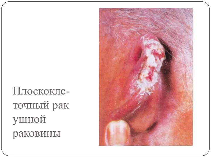 Плоскокле- точный рак ушной раковины