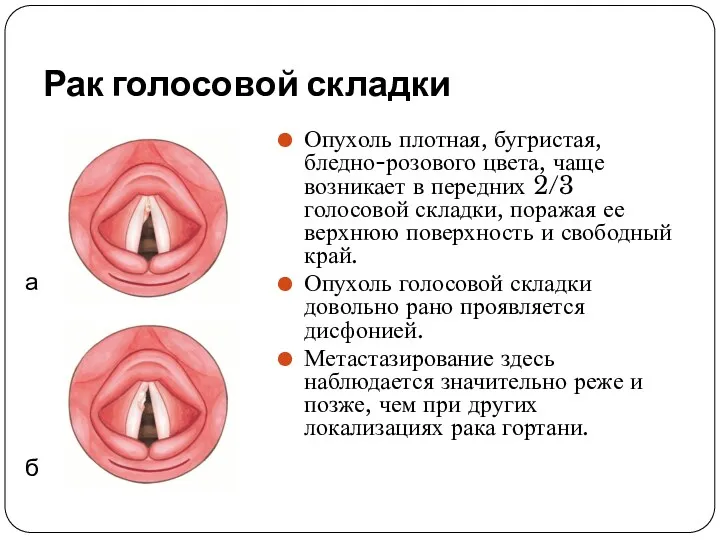 Рак голосовой складки Опухоль плотная, бугристая, бледно-розового цвета, чаще возникает