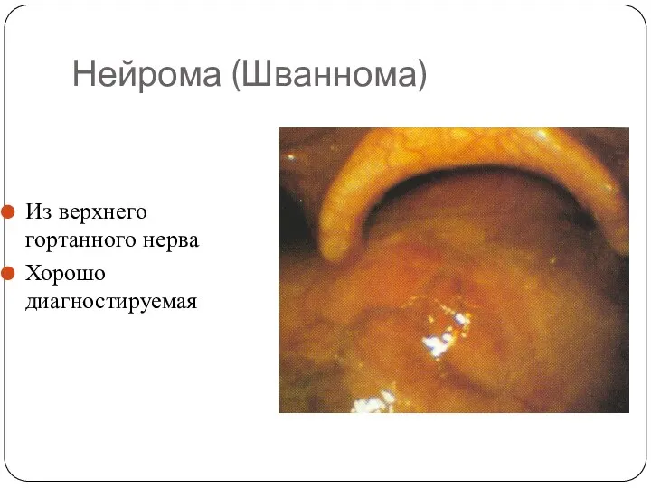 Нейрома (Шваннома) Из верхнего гортанного нерва Хорошо диагностируемая