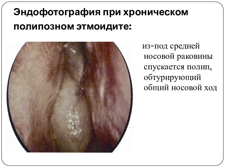 Эндофотография при хроническом полипозном этмоидите: из-под средней носовой раковины спускается полип, обтурирующий общий носовой ход