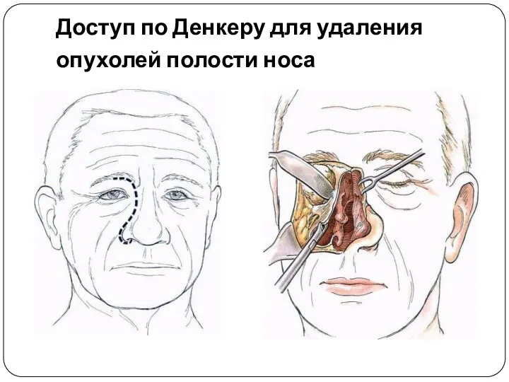 Доступ по Денкеру для удаления опухолей полости носа