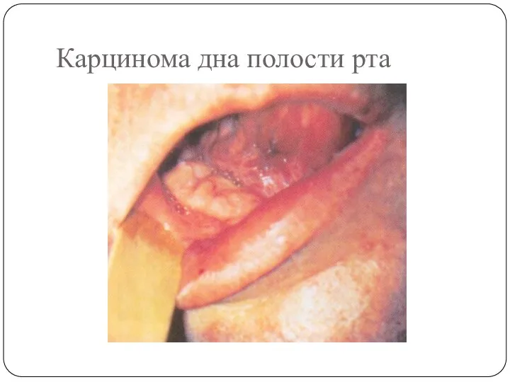 Карцинома дна полости рта