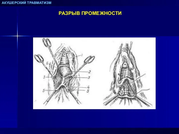 АКУШЕРСКИЙ ТРАВМАТИЗМ РАЗРЫВ ПРОМЕЖНОСТИ