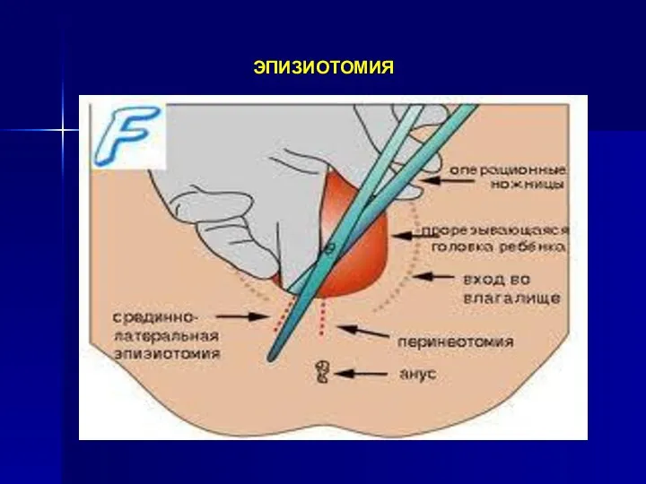 ЭПИЗИОТОМИЯ