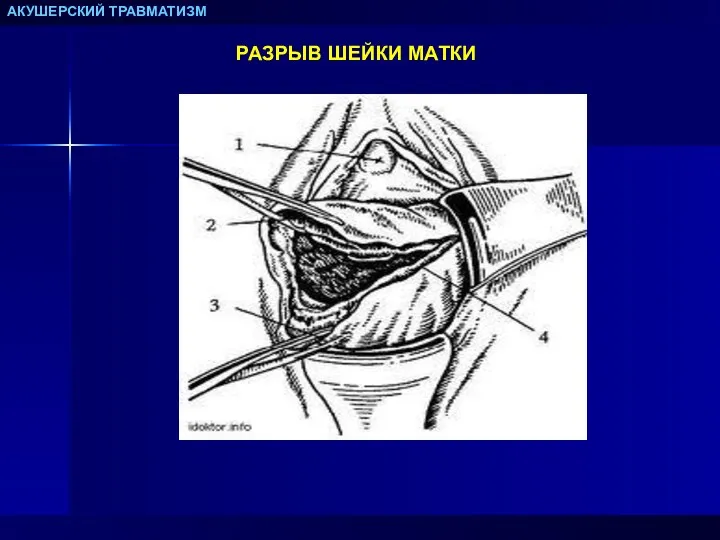 АКУШЕРСКИЙ ТРАВМАТИЗМ РАЗРЫВ ШЕЙКИ МАТКИ