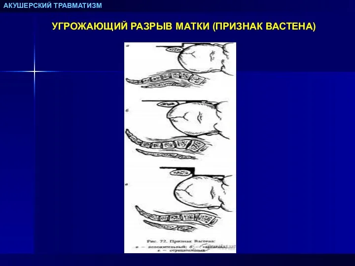 АКУШЕРСКИЙ ТРАВМАТИЗМ УГРОЖАЮЩИЙ РАЗРЫВ МАТКИ (ПРИЗНАК ВАСТЕНА)