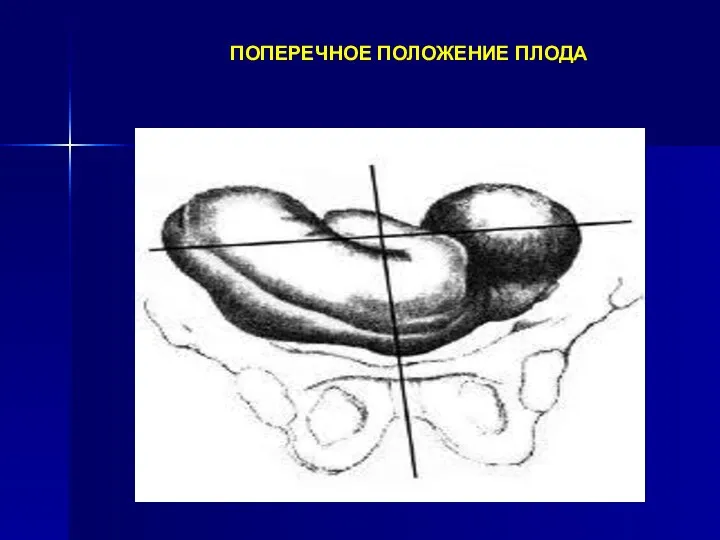 ПОПЕРЕЧНОЕ ПОЛОЖЕНИЕ ПЛОДА