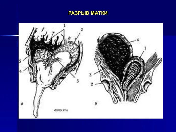 РАЗРЫВ МАТКИ