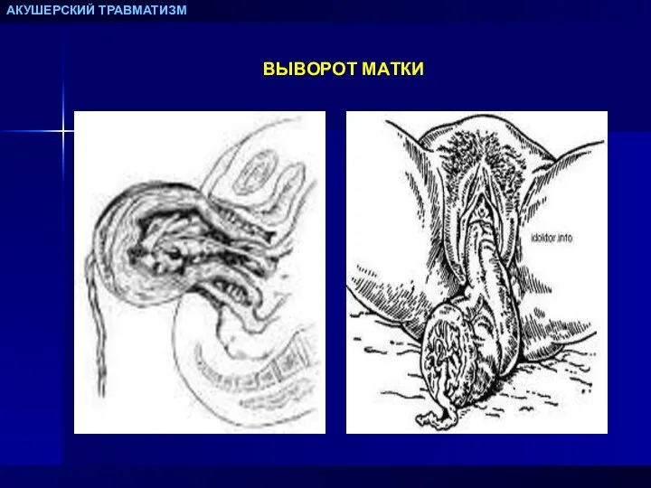 АКУШЕРСКИЙ ТРАВМАТИЗМ ВЫВОРОТ МАТКИ
