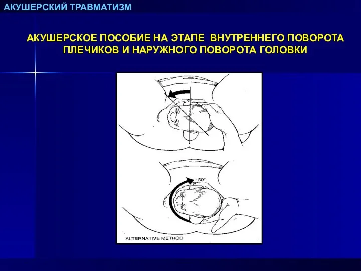 АКУШЕРСКИЙ ТРАВМАТИЗМ АКУШЕРСКОЕ ПОСОБИЕ НА ЭТАПЕ ВНУТРЕННЕГО ПОВОРОТА ПЛЕЧИКОВ И НАРУЖНОГО ПОВОРОТА ГОЛОВКИ