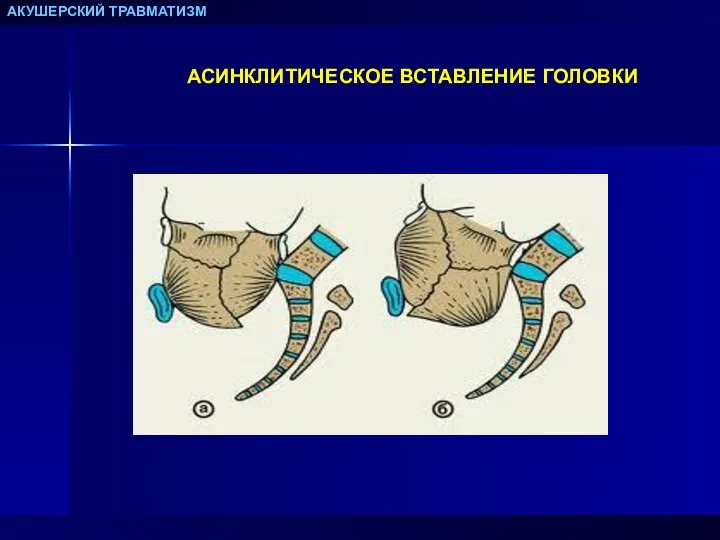 АКУШЕРСКИЙ ТРАВМАТИЗМ АСИНКЛИТИЧЕСКОЕ ВСТАВЛЕНИЕ ГОЛОВКИ